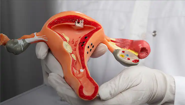 Can Calabash Chalk Cause Fibroids? - Understanding fibroids